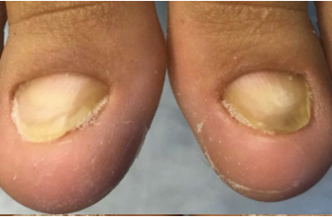 Deforme Tırnak Bakımı